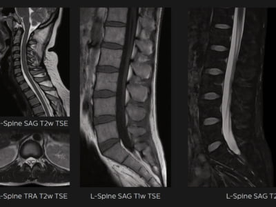 Ressonância Magnética Philips Ingenia Prodiva CS - Imagem Clínica - Coluna