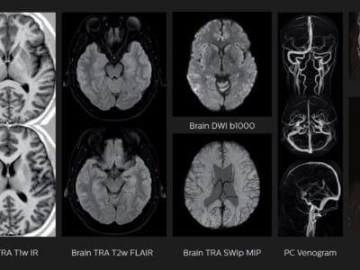 Ressonância Magnética Philips Ingenia Prodiva CS - Imagem Clínica - Neuro