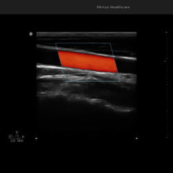 CarótidaPhilips Ultrassom 3300 Imagem Clínica - Carótida