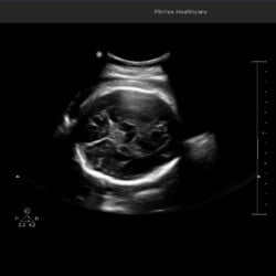 Philips Ultrassom 3300 Imagem Clínica - Cérebro Fetal