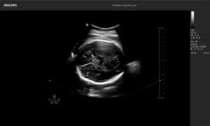 Philips Ultrassom 3300 Imagem Clínica - Cérebro Fetal