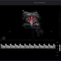 Philips Ultrassom 3300 Imagem Clínica - Doppler Renal