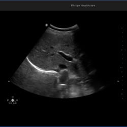 Philips Ultrassom 3300 Imagem Clínica - Fígado