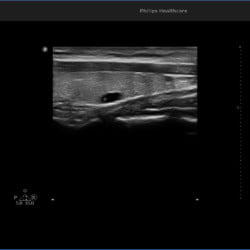 Philips Ultrassom 3300 Imagem Clínica - Tireóide