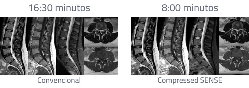 Ressonância Magnética Philips MR 5300 - 27 - Compressed SENSE
