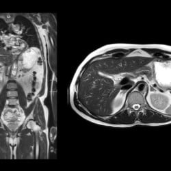 Ressonância Magnética Philips MR 5300 - Imagem Clínica - 2