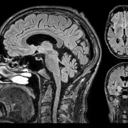 Ressonância Magnética Philips MR 5300 - Imagem Clínica - 5