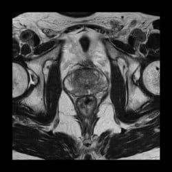 Ressonância Magnética Philips MR 5300 - Imagem Clínica - 6