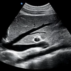 Ultrassom Portátil Philips Compacto 5000 - Imagem Clínica 1