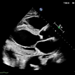 Ultrassom Philips Affiniti CVx - Transdutor Setorial S5-1