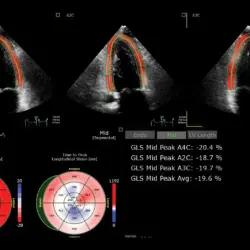 Ultrassom Philips Affiniti CVx - AutoStrain LV TOMTEC Miocárdio e AutoEF