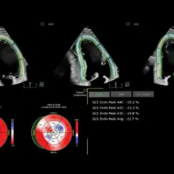 Ultrassom Philips Affiniti CVx - AutoStrain LV TOMTEC