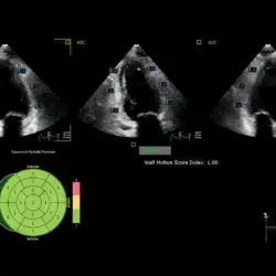 Ultrassom Philips Affiniti CVx - Auto Segmental Wall Motion Scoring