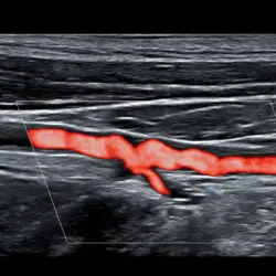 Ultrassom Philips Affiniti CVx - Transdutor Linear eL18-4