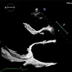 Ultrassom Philips Affiniti CVx - Transdutor Transtorácico X5-1 - 2