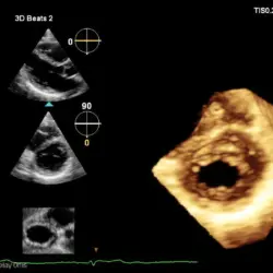 Ultrassom Philips Affiniti CVx - Transdutor Transtorácico X5-1