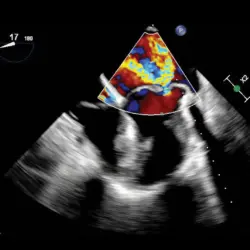 Ultrassom Philips Affiniti CVx - Transdutor Transesofágico X8-2t