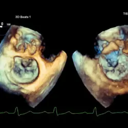 Ultrassom Philips Affiniti CVx - Transdutor Transesofágico X7-2t