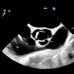 Ultrassom Philips Affiniti CVx - Transdutor Transesofágico X8-2t - 2