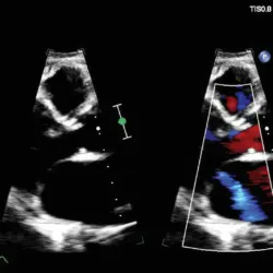 Ultrassom Philips Affiniti CVx - Imagem Clínica - 9