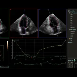 Ultrassom Philips Affiniti CVx - Dynamic Heart Model