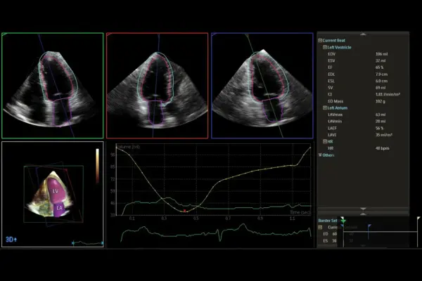 Ultrassom Philips Affiniti CVx - Dynamic Heart Model